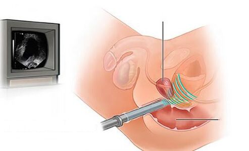 Ultraschall der Prostata