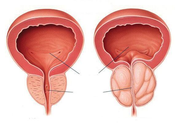 normale Prostata und Prostataentzündung